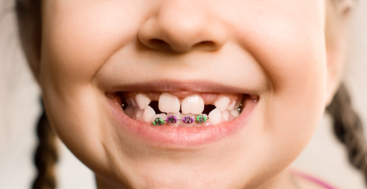 Apparecchio denti bambini? Ecco cosa serve sapere!